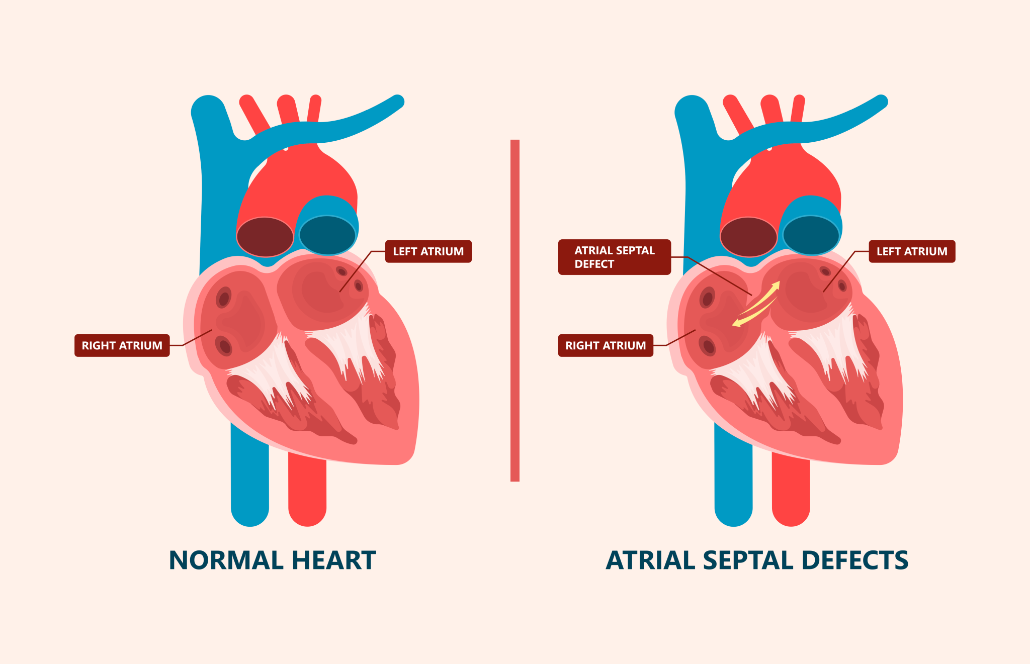 Atrial Septal Defect Treatments | Prof Theo Kofidis Singapore